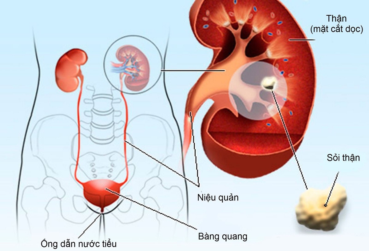 4 thong tin ve soi nieu quan va phuong phap dieu tri 670cfb28dbe16