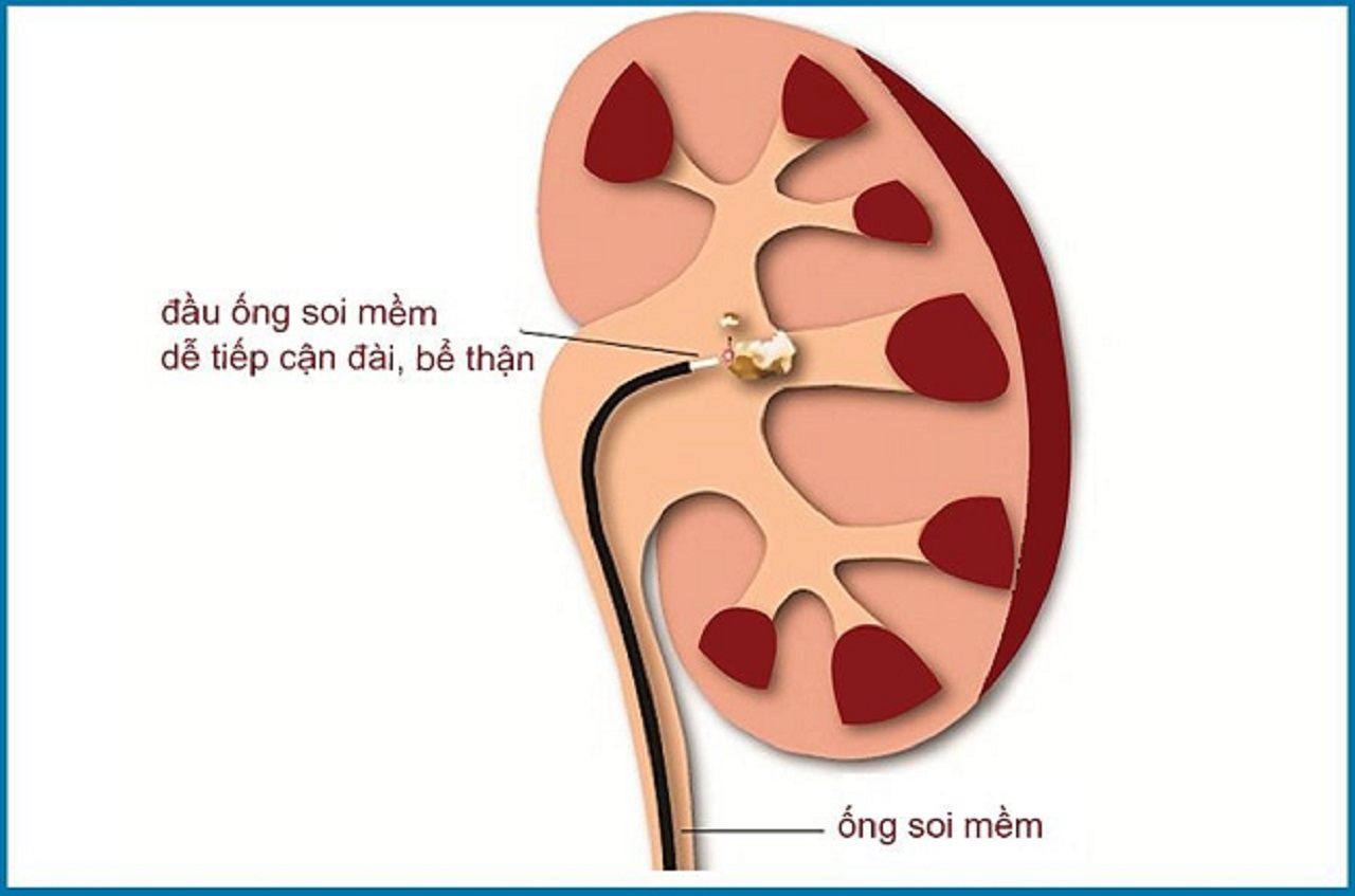 5 dieu can phai biet ve tan soi than bang ong mem 670cfa42d02ad