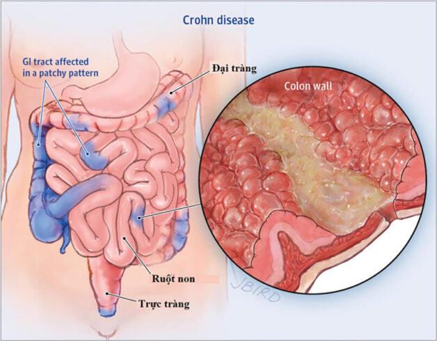 benh crohn la gi trieu chung va cach dieu tri 670e98be775f5