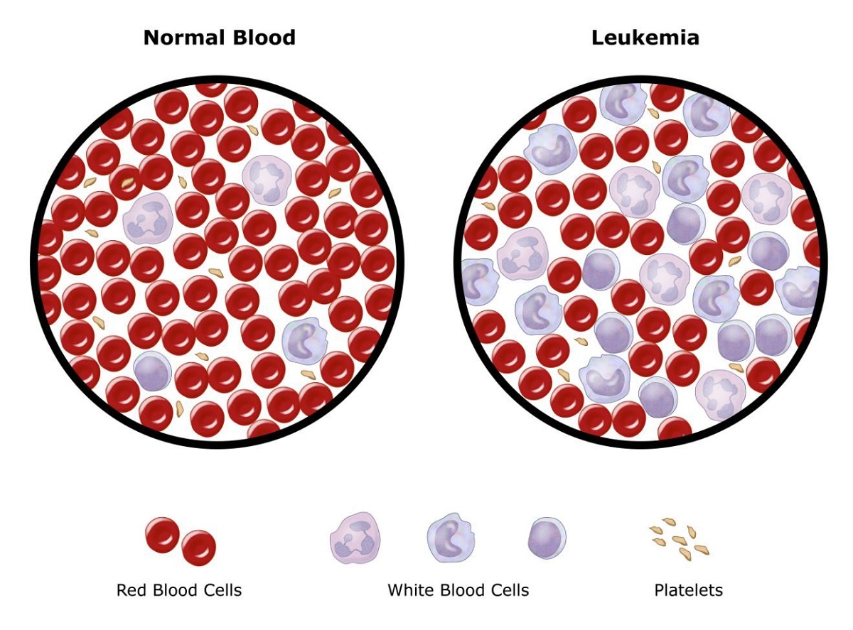 benh leukemia la gi nguyen nhan cach chan doan va dieu tri 670d02b6271ba