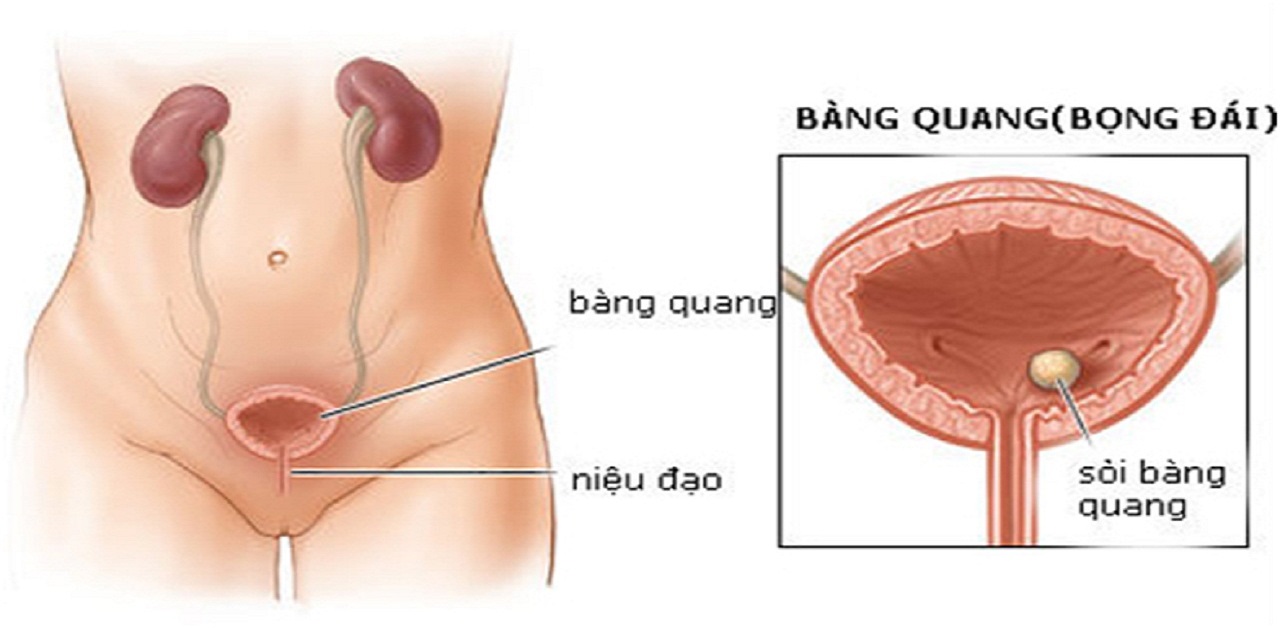 benh soi bang quang dau hieu nguyen nhan va cach phong ngua 670cf76ab52e3