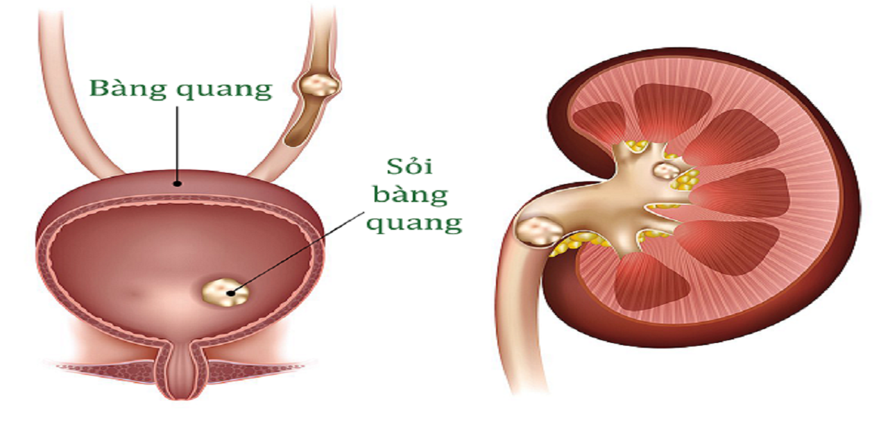 benh soi bang quang kieng gi de nhanh khoi 670cf40e2a974