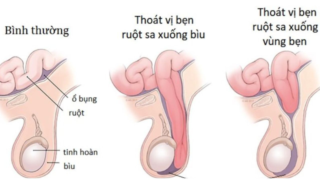 benh thoat vi ben nguyen nhan trieu chung va dieu tri 670d1b5372b1a