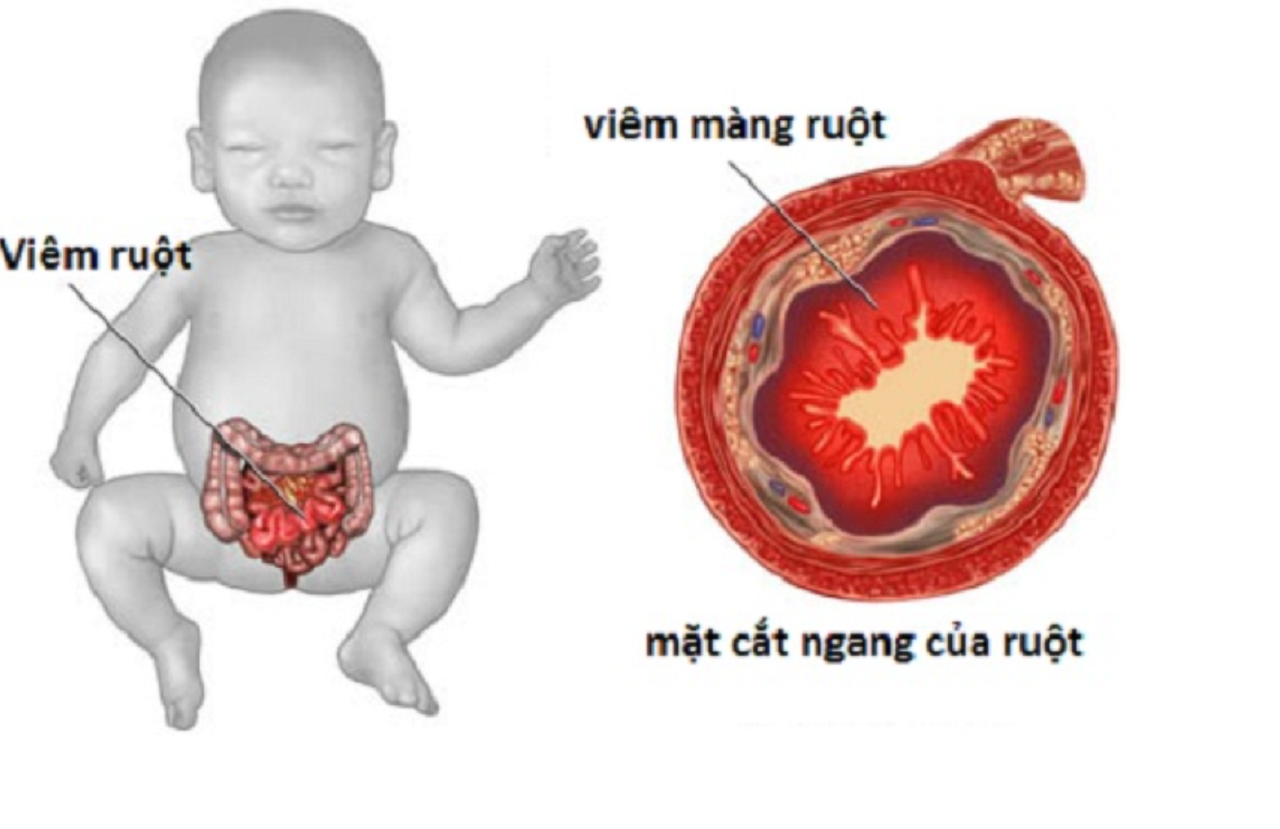 benh viem ruot hoai tu o tre nguyen nhan dau hieu va dieu tri 670e9ad11765b