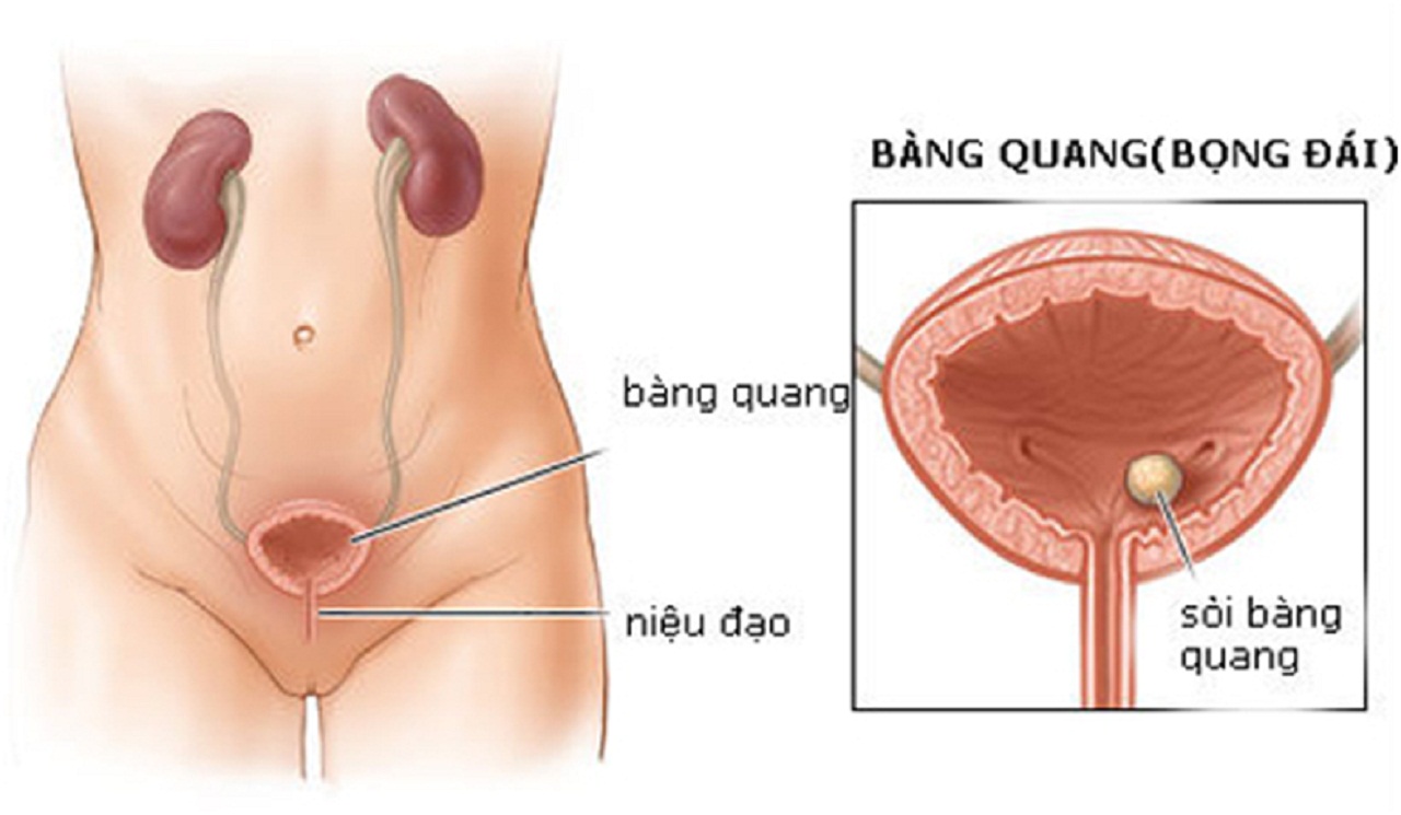 bi soi bang quang nen an gi va khong nen an gi giai dap 670cfabea690c