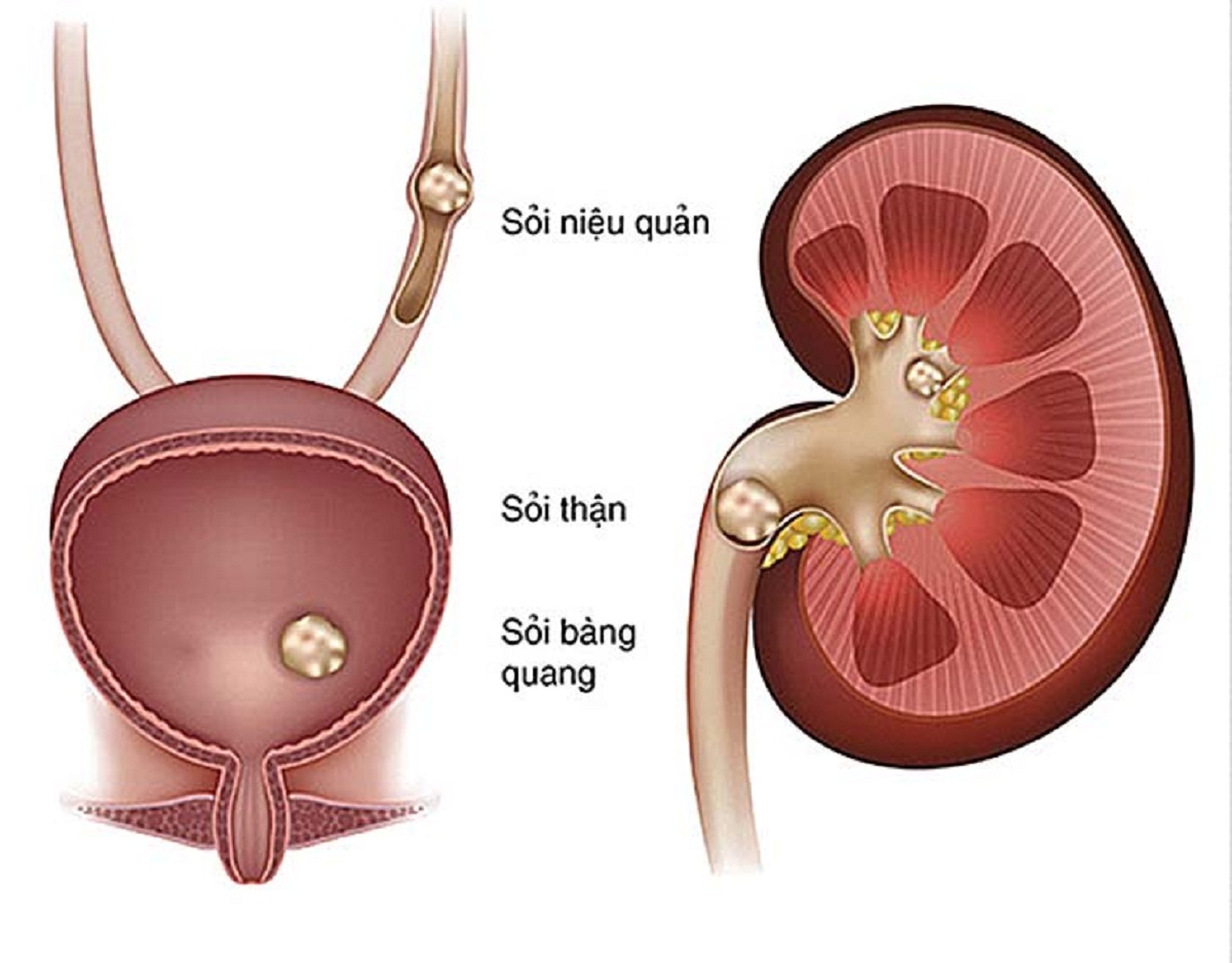 cac loai soi tiet nieu thuong gap va phuong phap dieu tri 670cfec242994