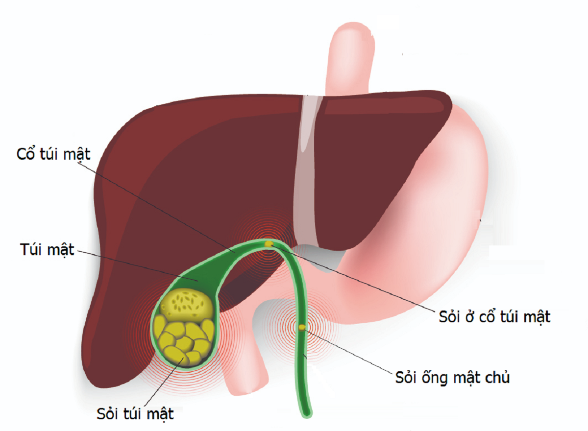 chan doan va phac do dieu tri soi duong mat hieu qua 670cff19ebc71