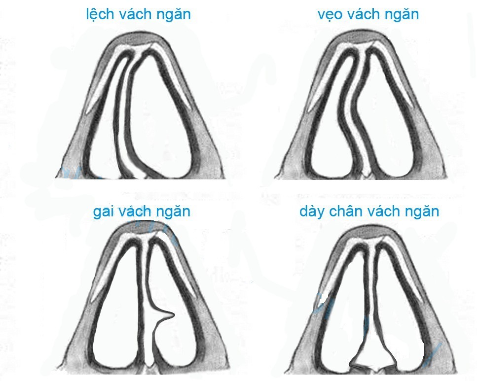 chinh hinh vach ngan mui duoc thuc hien nhu the nao 670d0842de7a4