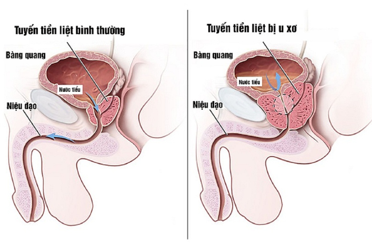 chua u xo tuyen tien liet bang phuong phap nao hieu qua 670cfcd918a52