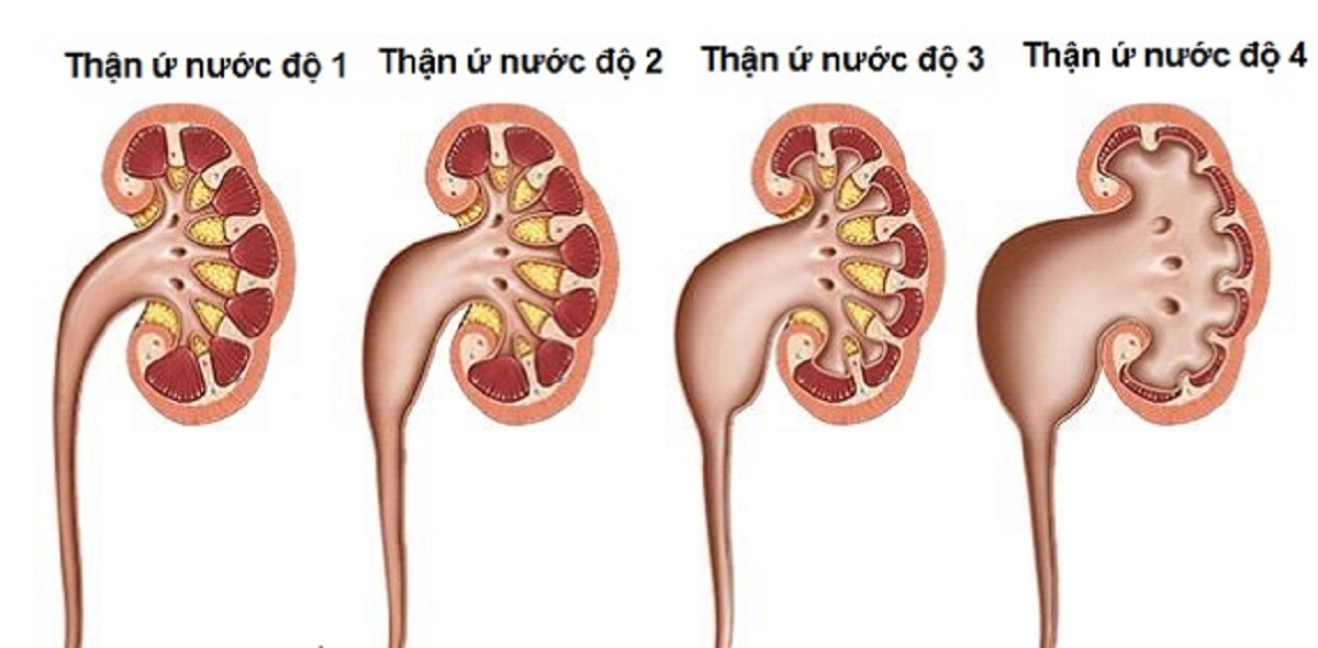 dau hieu nhan biet va phuong phap dieu tri soi than u nuoc 670cfd0c5f82d