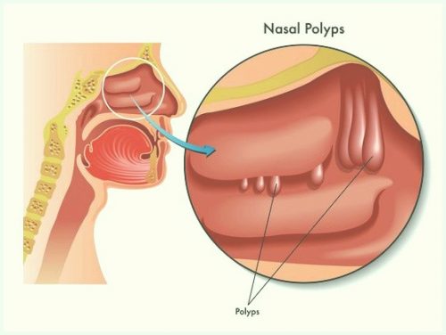 dieu tri benh polyp mui o dau tai ha noi 670d04c0159ef