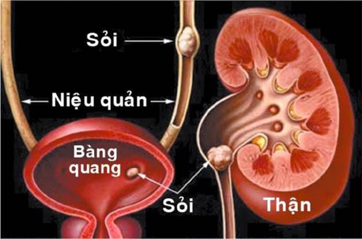 dung chu quan voi hien tuong soi than o bang quang 670cfd3f5db3c