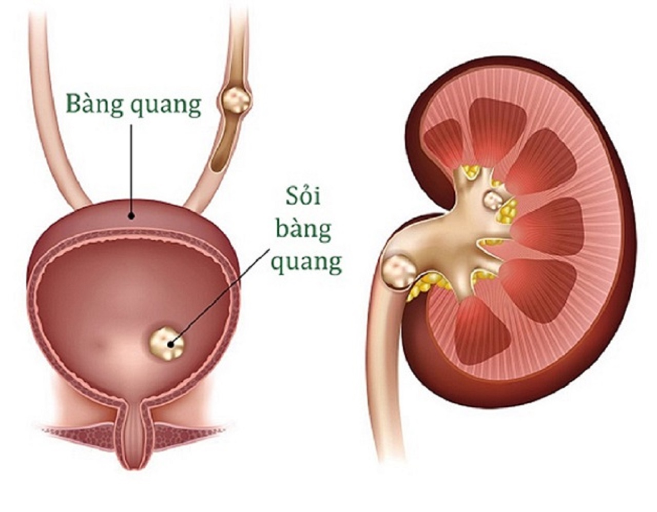 giai dap soi bang quang 5mm co nguy hiem khong 670cf542b7e1b