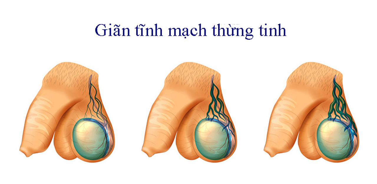 gian tinh mach thung tinh nguyen nhan gay benh chan doan va dieu tri 670cf51e709e7