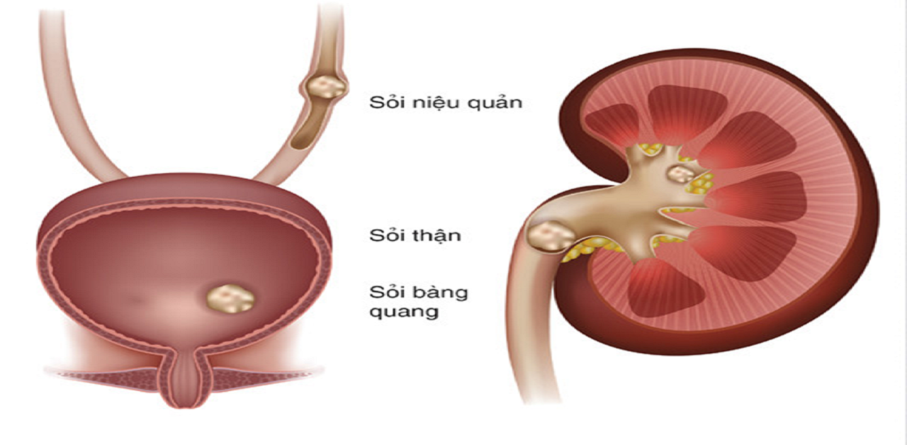 goc giai dap soi nieu quan bao nhieu thi phai mo 670cf65c11cd4