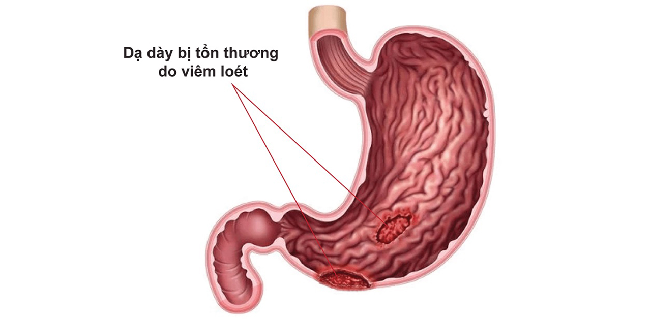 mach ban cac cach tri loet bao tu hieu qua 670e9e8fa54bc