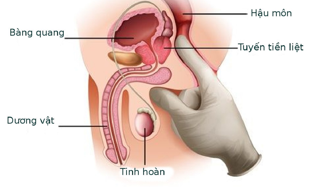 mo dieu tri u xo tien liet tuyen bang laser nhung dieu can biet 670cf78027d13