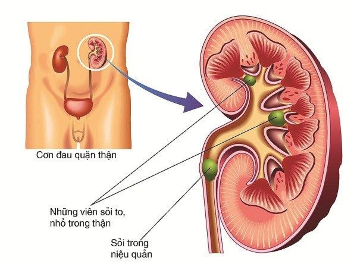 mo noi soi soi tiet nieu va 5 thong tin can biet de dieu tri hieu qua 670cfba61d805