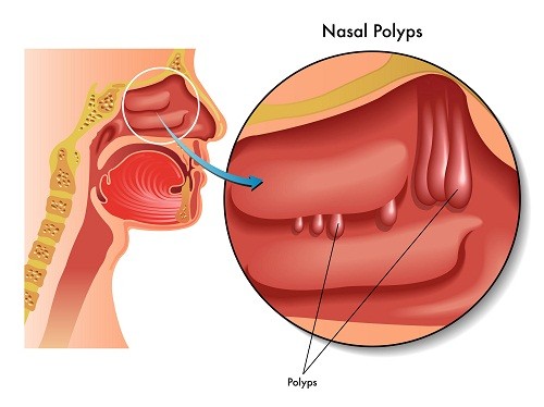 mo polyp mui bao nhieu tien co hieu qua khong 670d0a683084d