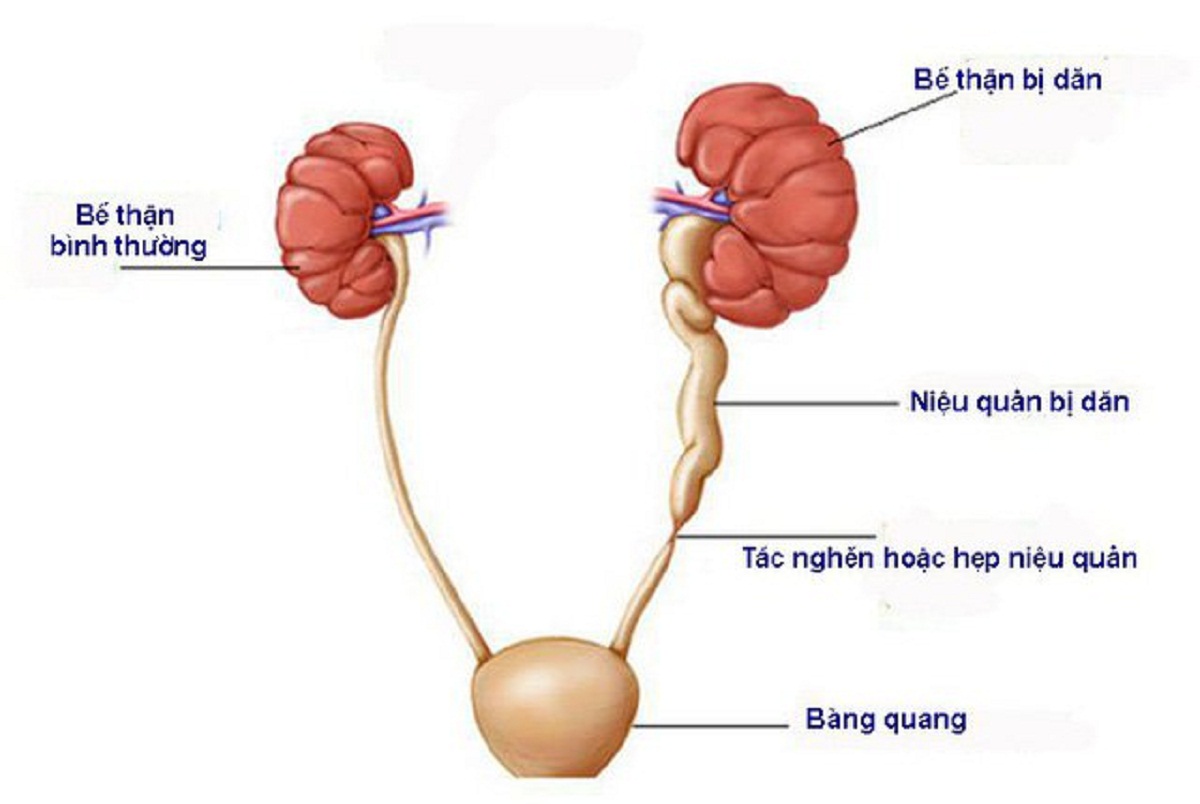 mo tao hinh nieu quan va nhung dieu nguoi benh can biet 670cfc6a38227