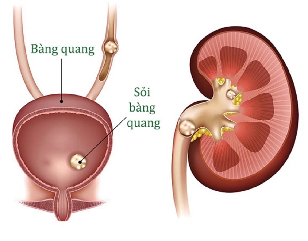 nhung dau hieu canh bao can benh soi bang quang 670cf4235ac63