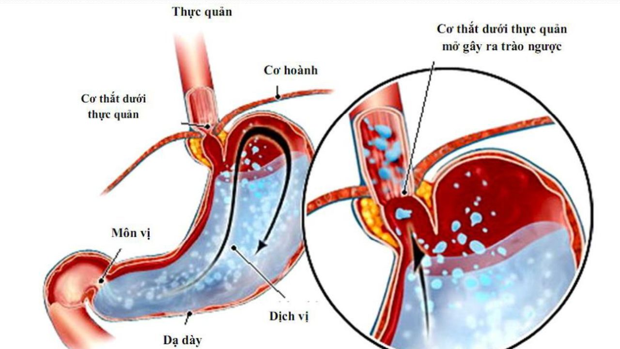 nhung dieu can biet ve chung trao nguoc axit da day thuc quan 670d3b2291388