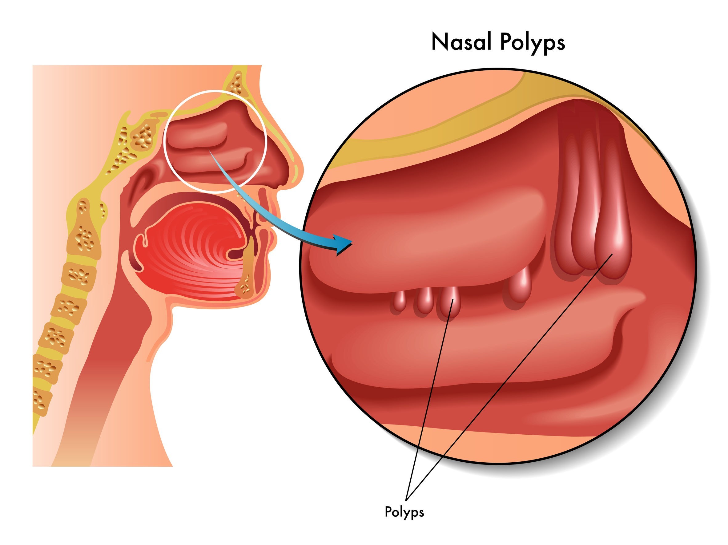 noi soi cat polyp mui gay kho tho giam hoac mat khuu giac 670d0c63aa229