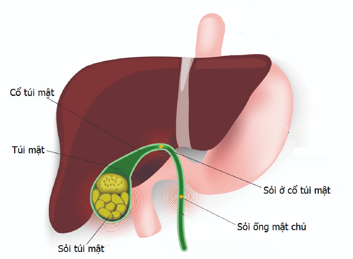 noi soi lay soi mat giai phap hieu qua trong dieu tri soi tui mat 670cfd6c38521