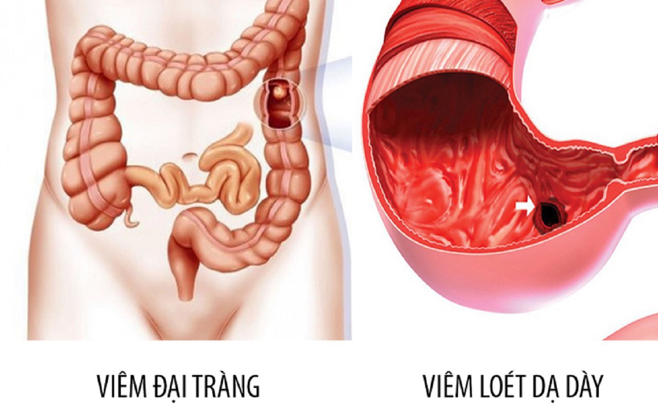 phan biet giua dau da day va dai trang 670e95a1a02cc