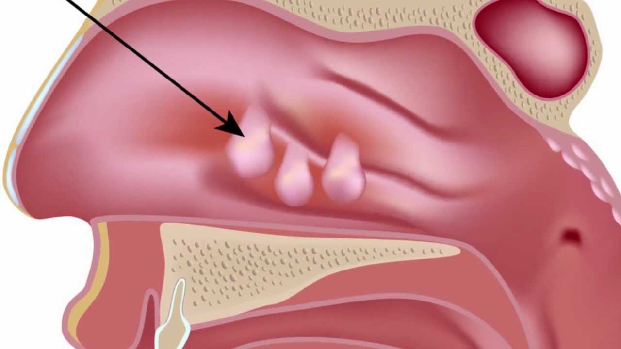 phau thuat noi soi polyp mui an toan hieu qua 670d084a5f84c