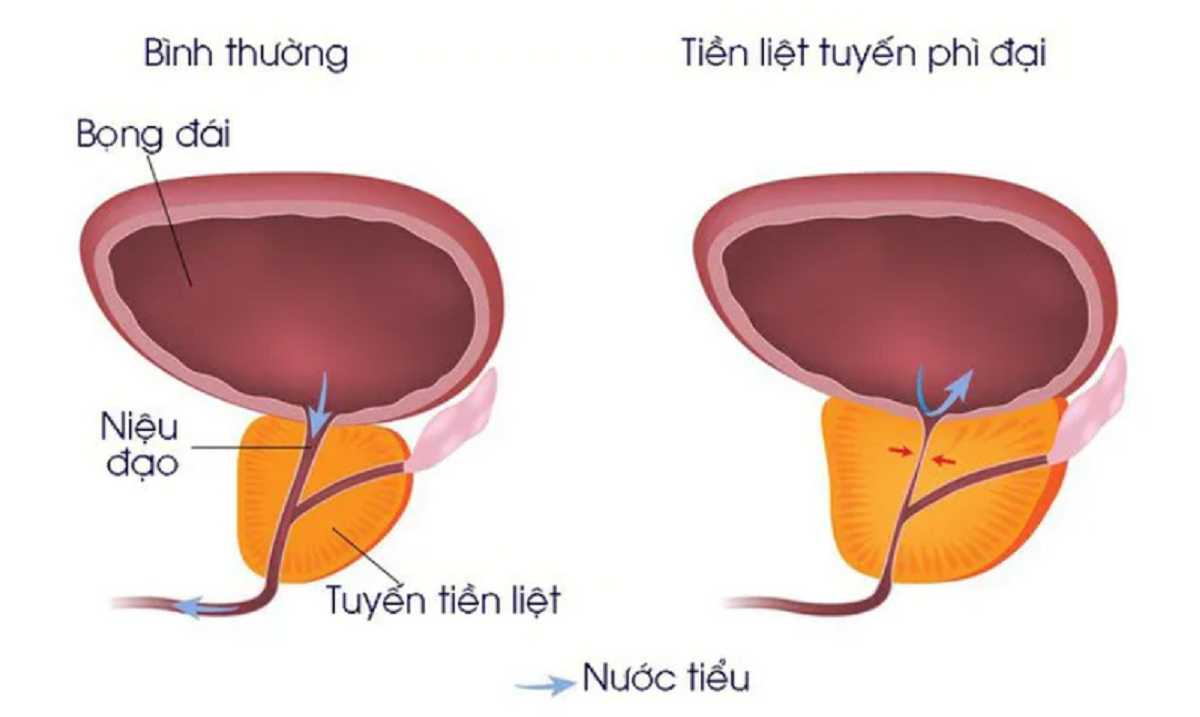 phau thuat u xo tuyen tien liet cham dut noi dau kho cho quy ong 670cfd7b12cac