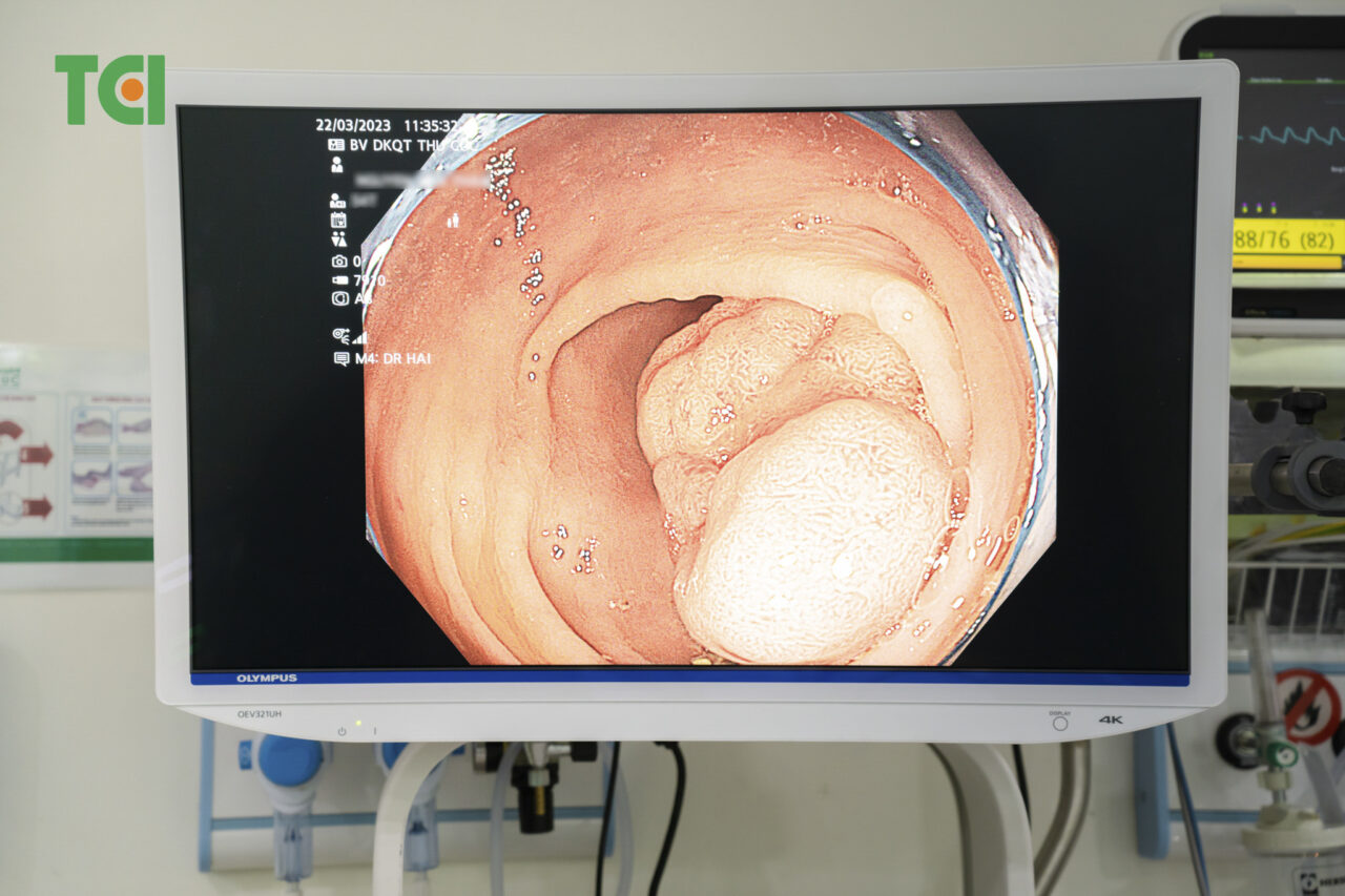 polyp dai trang co gay tao bon khong dieu tri ra sao 670d4429a1d4b