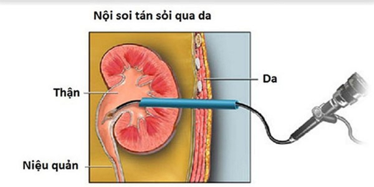 tan soi qua da buoc tien moi trong dieu tri soi tiet nieu 670cfd5dace8b