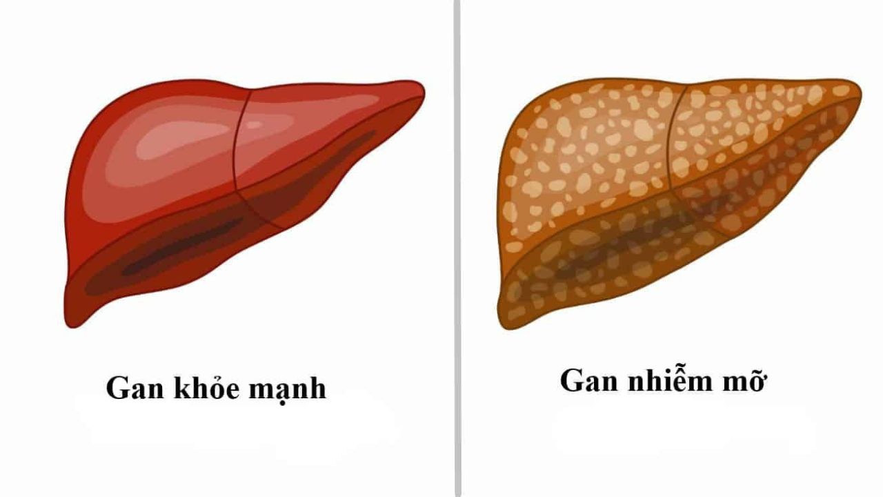 thuoc cho benh nhan gan nhiem mo va nhung luu y khi su dung 670d3fe61d824