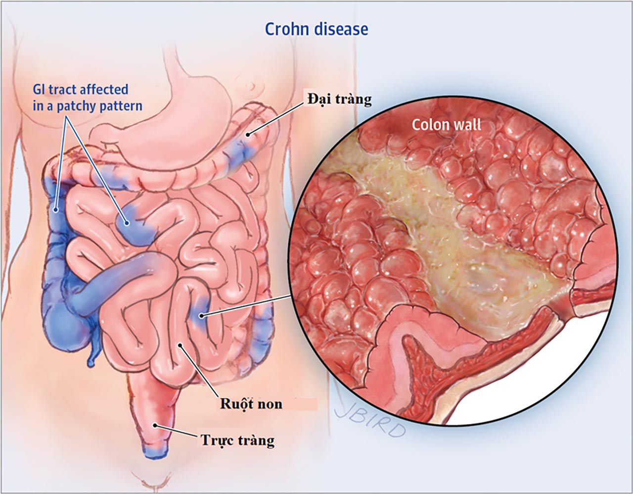 tong quan nguyen nhan trieu chung va cach dieu tri benh crohn 670ea107a9c1b