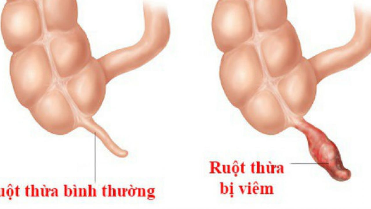 trieu chung viem ruot thua va cach dieu tri hieu qua 670cfa8a91e6b