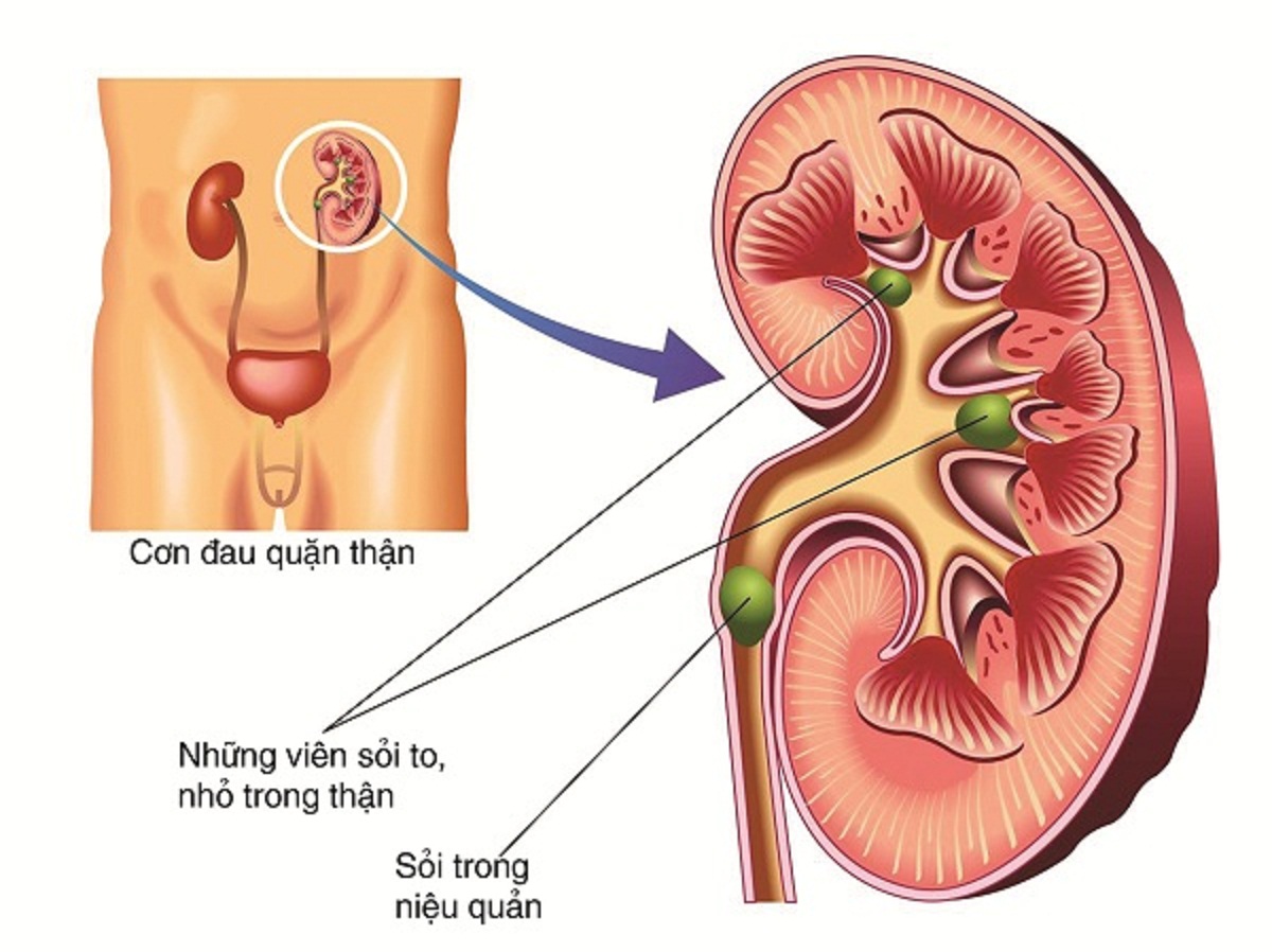 truong hop nao can mo noi soi hong lung lay soi tiet nieu 670cfd30b0ba9