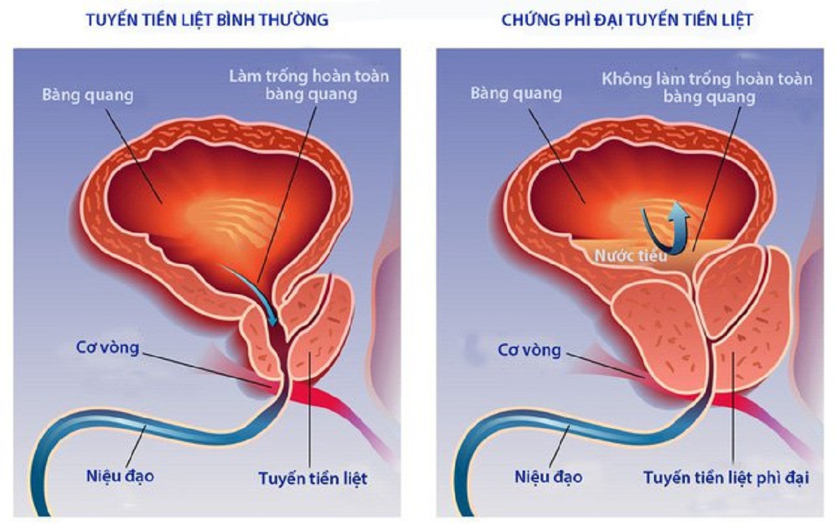 u xo tuyen tien liet benh hoc benh cua da so dan ong 670cfceebb727