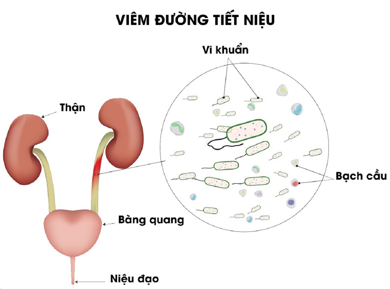 viem duong tiet nieu tieu ra mau co nguy hiem khong 670cf8ac07cb1