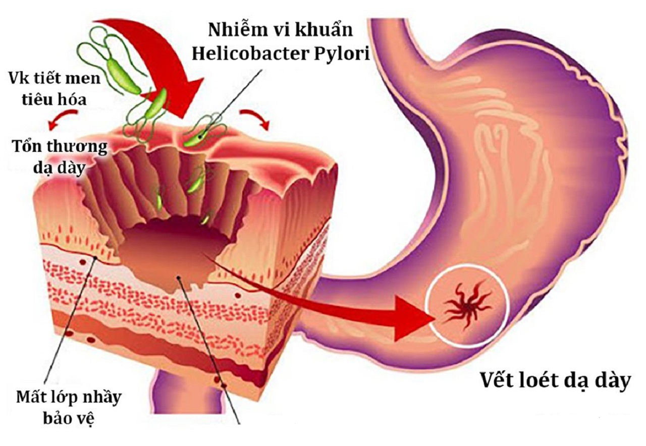 viem hp da day co nguy hiem khong cach dieu tri 670e97085adf7