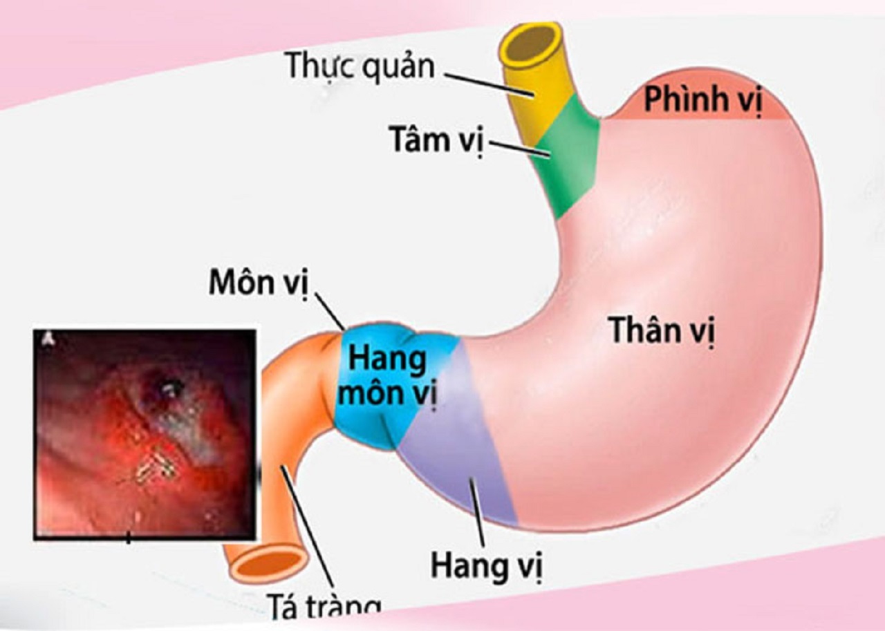 viem mon vi da day va nhung dieu can biet 670e9e025d088