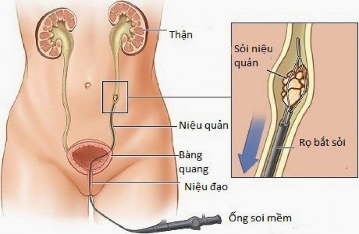 xoa tan soi tiet nieu voi tan soi nguoc dong bang laser 670cfd37df379